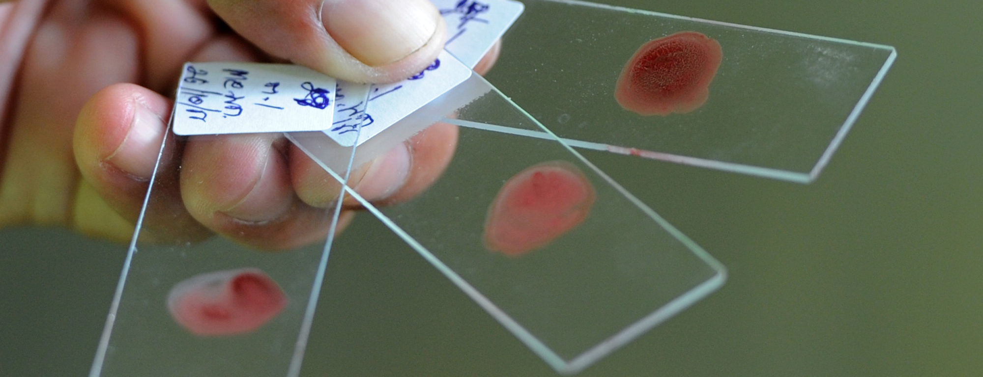 This teenager could revolutionize malaria testing with a cheap smartphone attachment