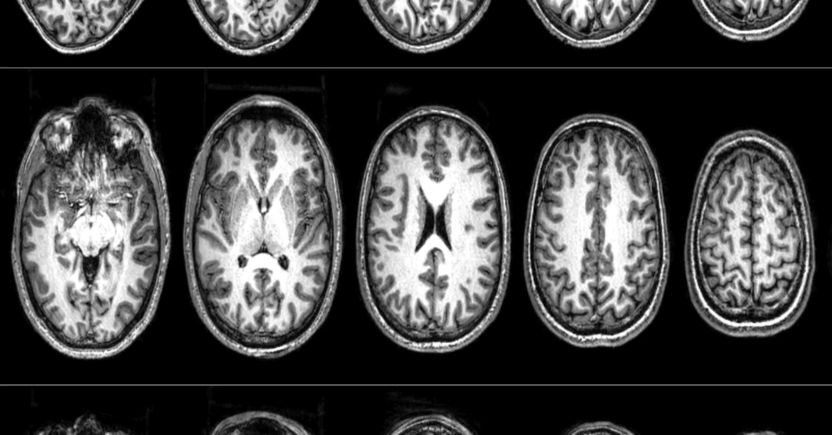Neuroscientists scanned radicals’ brains to determine what makes them turn violent
