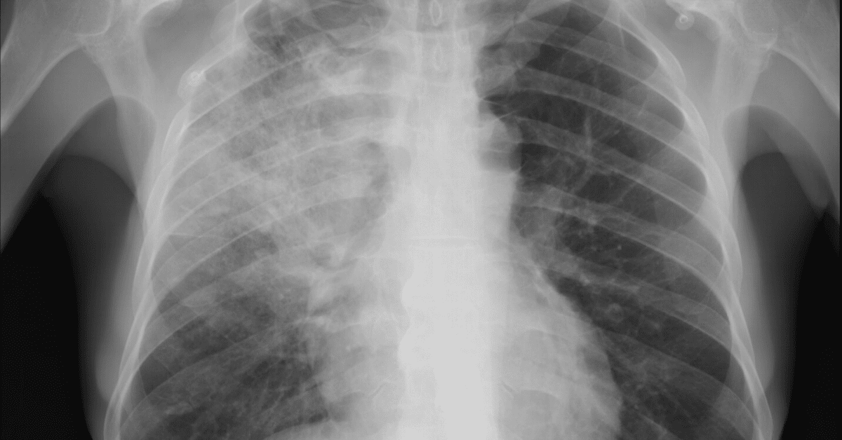 Claims that AI detects coronavirus in X-rays aren’t convincing medical experts