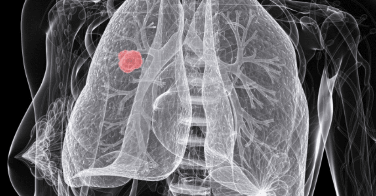 Scientists are using AI to predict which lung cancer patients will relapse