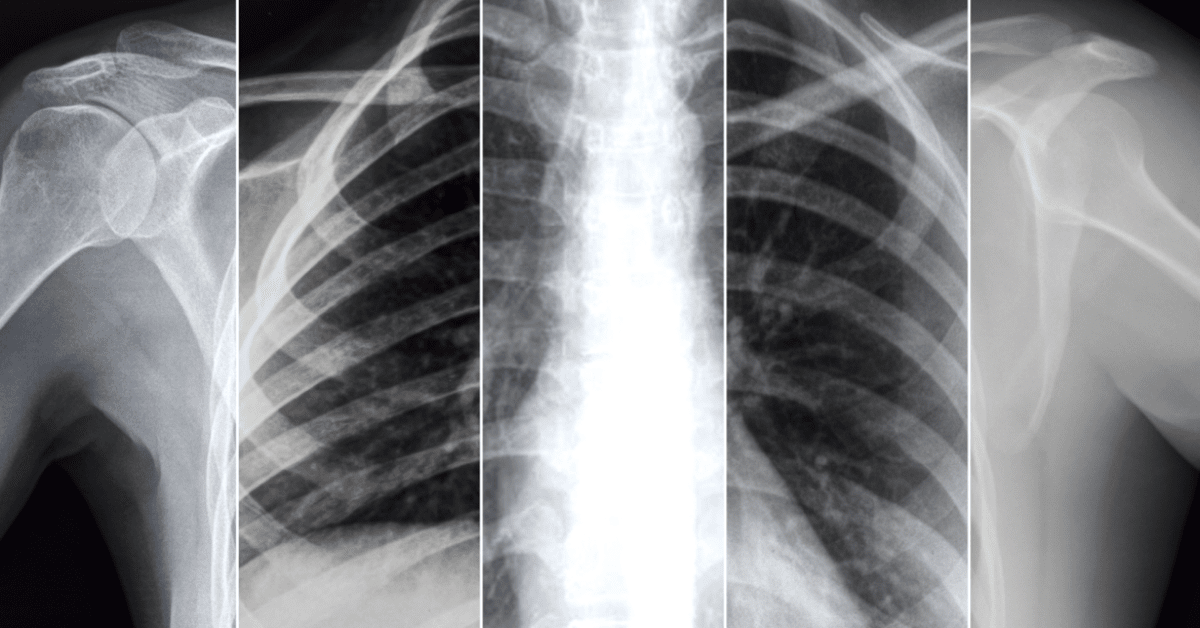 New self-supervised AI models scan X-rays to predict prognosis of COVID-19 patients